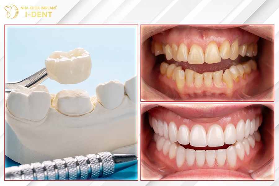 Bọc răng sứ giúp cải thiện vẻ ngoài thẩm mỹ của răng.