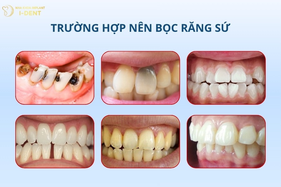 bọc răng sứ