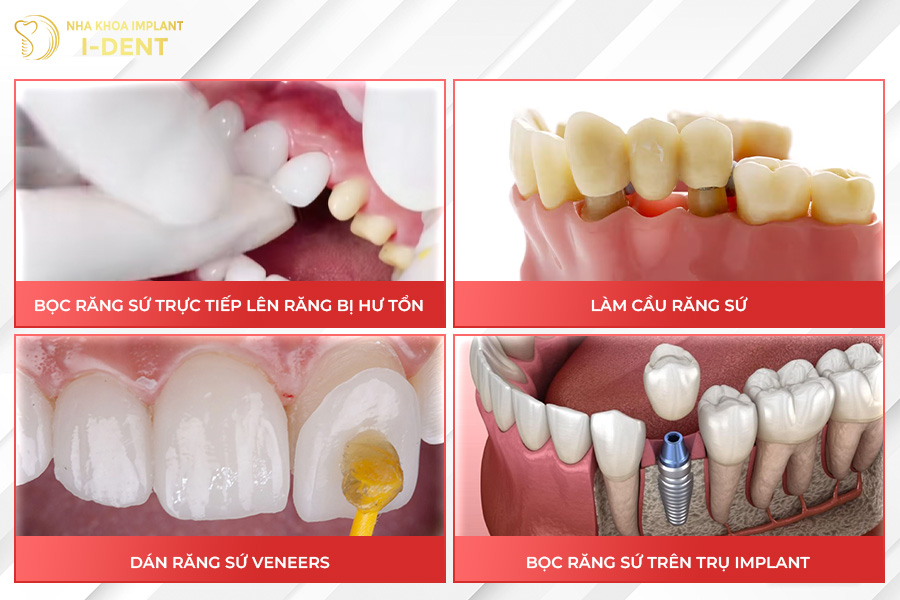 Các loại bọc răng sứ phổ biến hiện nay.