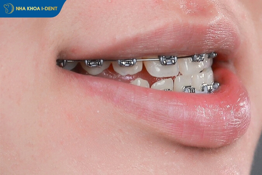 chi phí niềng răng móm