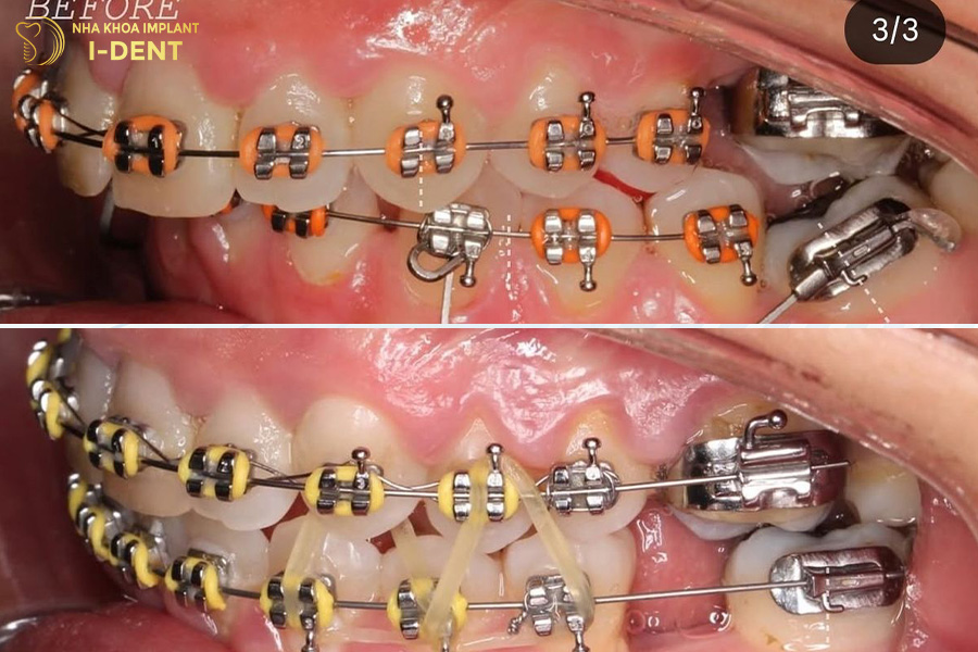 niềng răng hô nặng