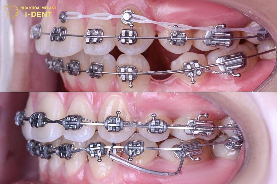 niềng răng hô nhẹ