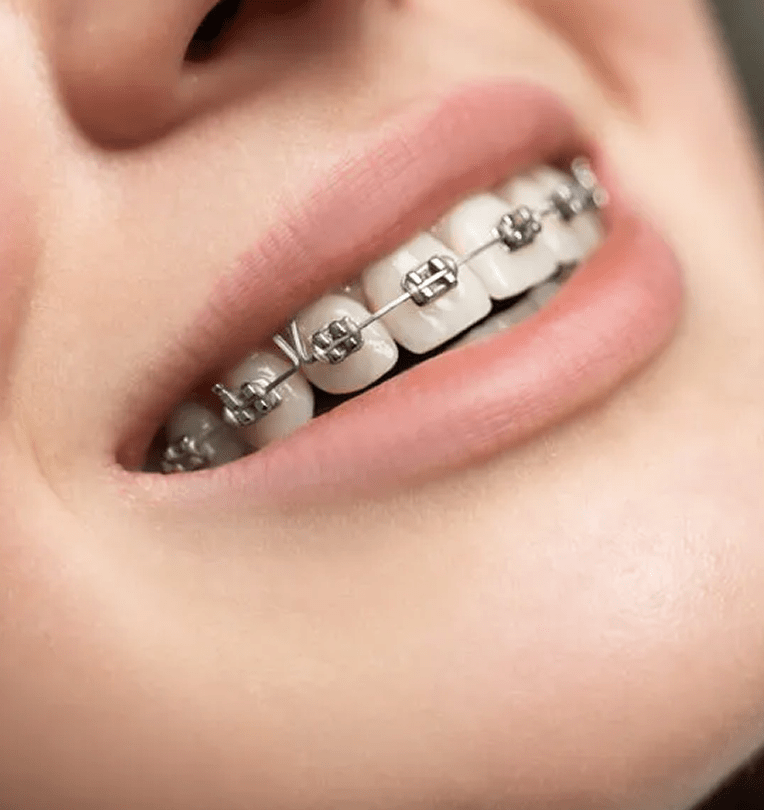 NIỀNG RĂNG MẮC CÀI KIM LOẠI