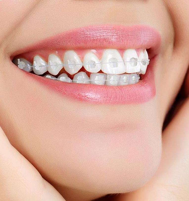 NIỀNG RĂNG MẮC CÀI SỨ