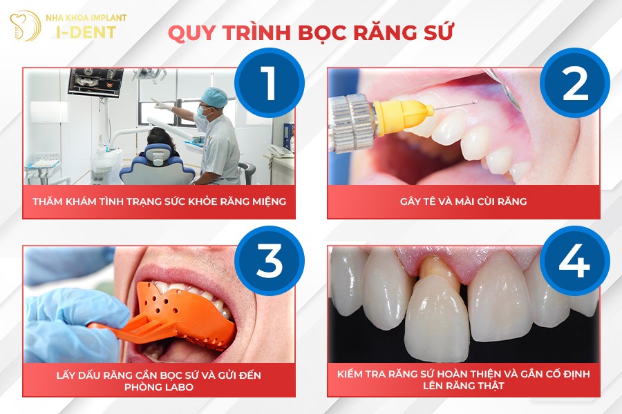 Quy trình bọc răng sứ chuẩn.