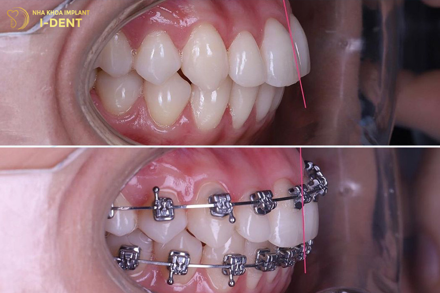 niềng răng hô nặng