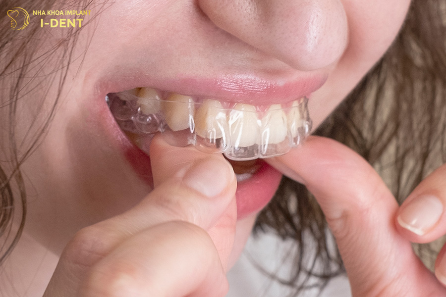 niềng răng hô nặng