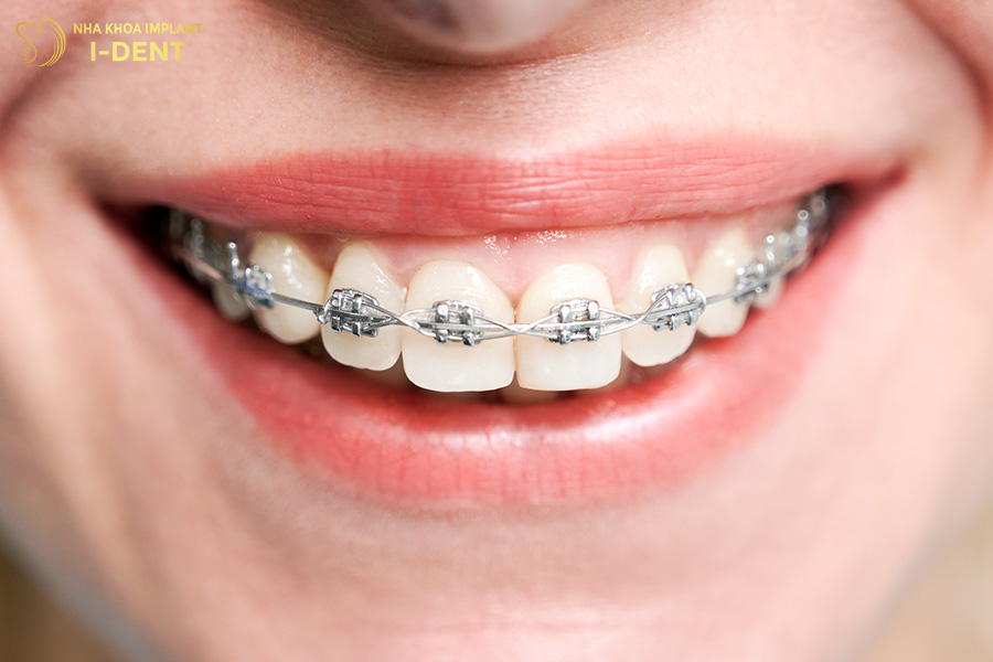 niềng răng hô nặng