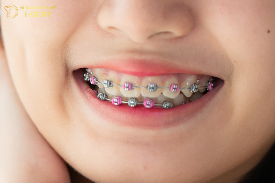 niềng răng hô nhẹ