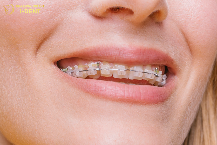 niềng răng hô nhẹ