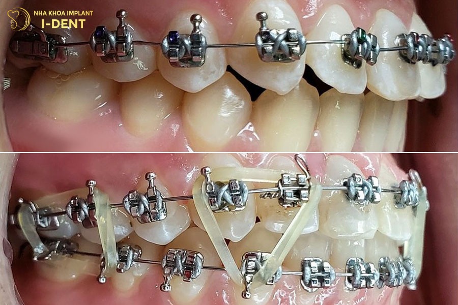 niềng răng hô nhẹ