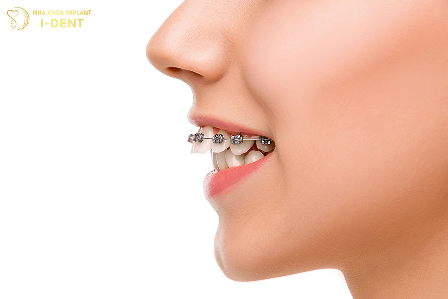 niềng răng hô nặng