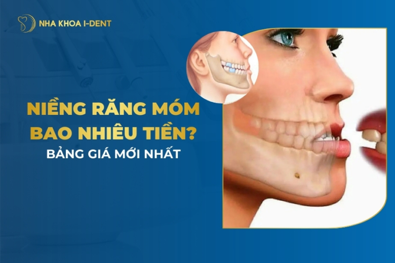 Niềng Răng Móm Giá Bao Nhiêu? Chi Phí Niềng 2026