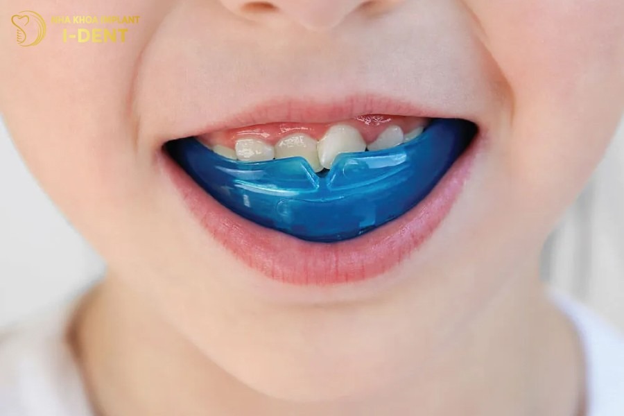 độ tuổi thích hợp niềng răng cho trẻ