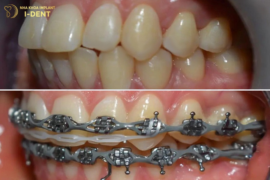 niềng răng hô nặng