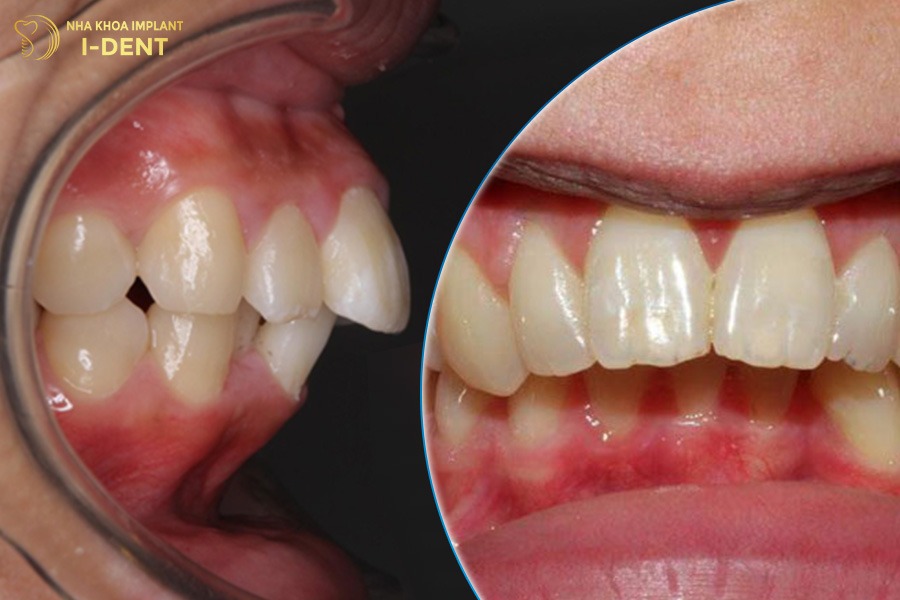 niềng răng hô nặng