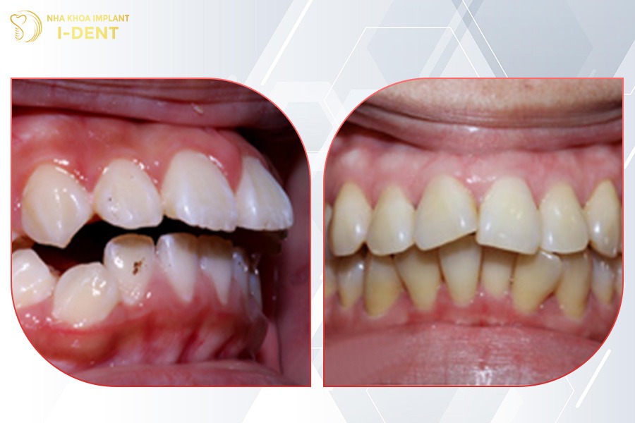 niềng răng hô nhẹ