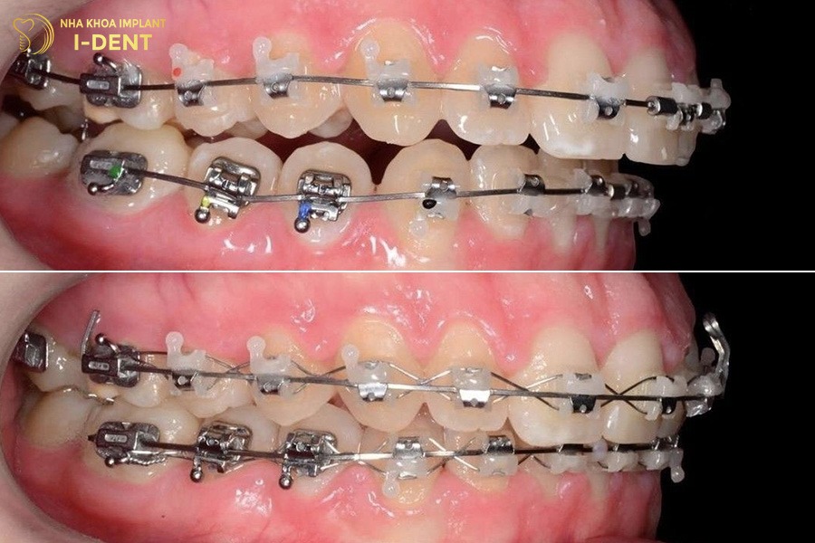 niềng răng hô nhẹ