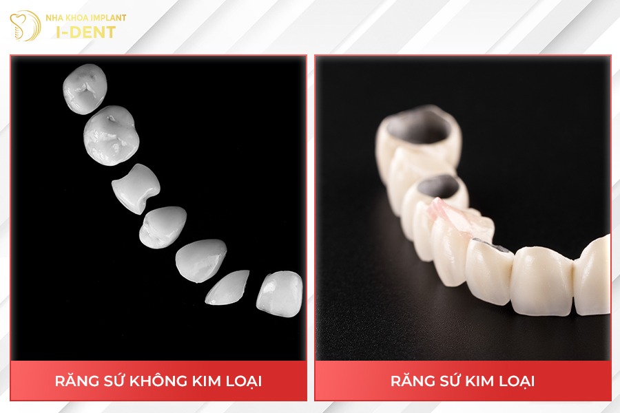 Răng sứ kim loại và răng sứ không kim loại (răng toàn sứ).