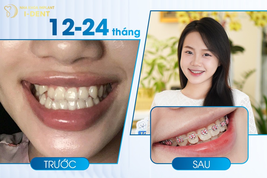 17 tuổi niềng răng bao nhiêu tiền