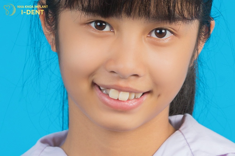 16 tuổi niềng răng bao lâu