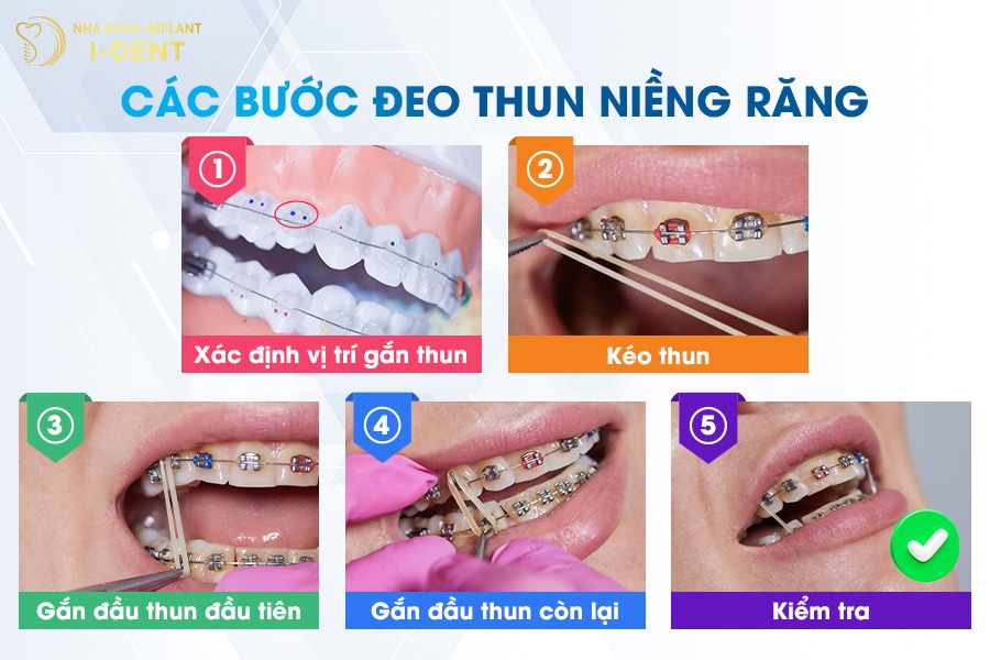 Cách đeo chun niềng răng.