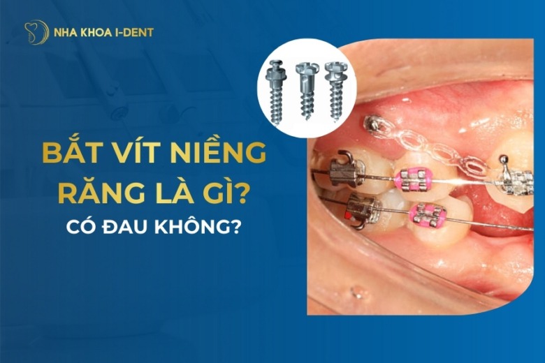 Bắt Vít Niềng Răng Là Gì? Bắt Vít Có Đau Không?