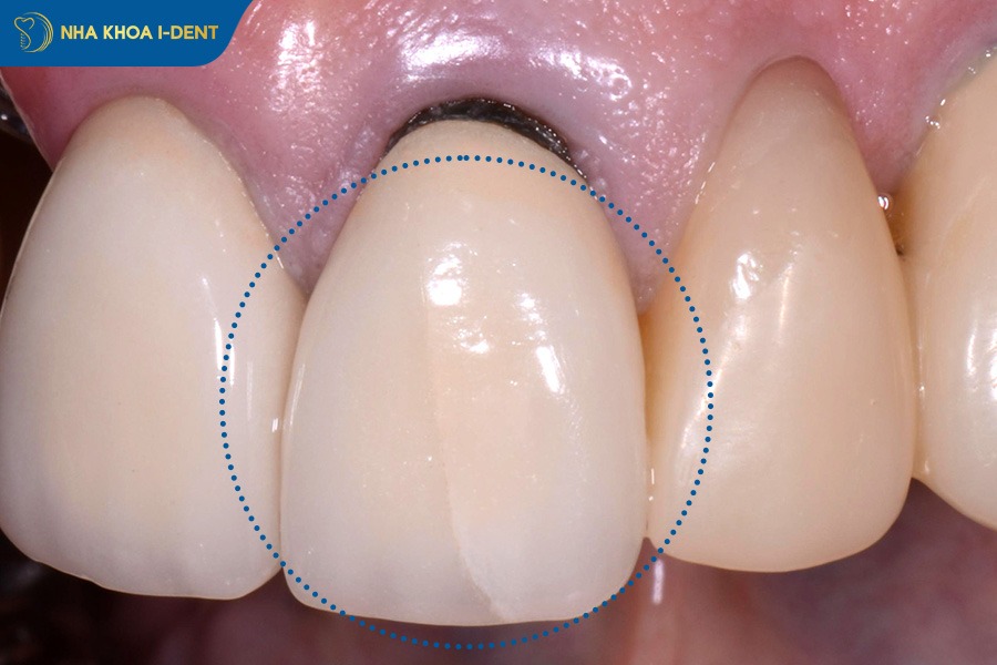 biểu hiện sau khi bọc răng sứ