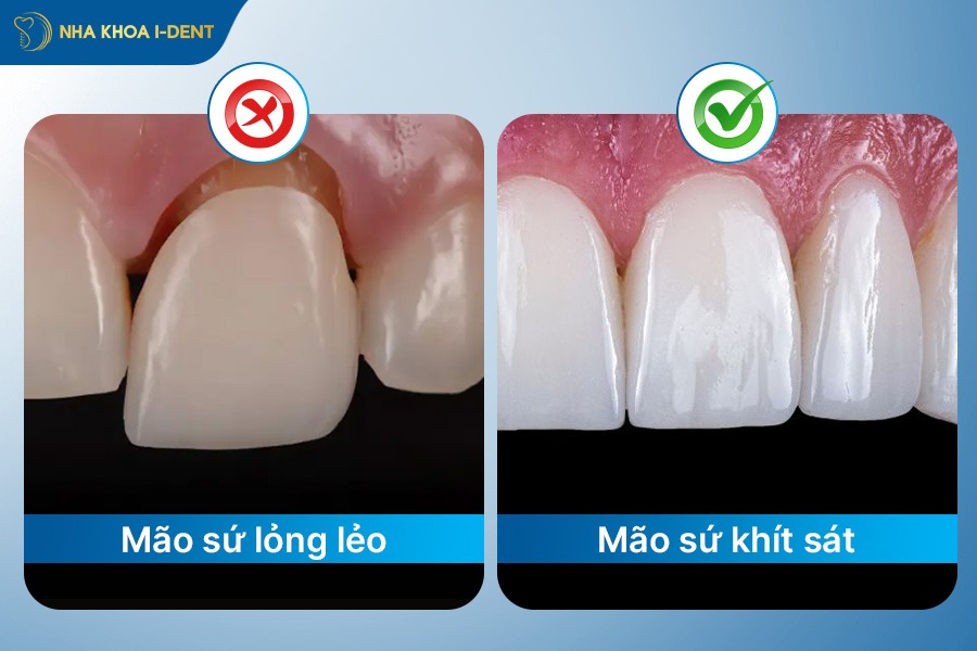 bọc răng sứ có niềng răng được không