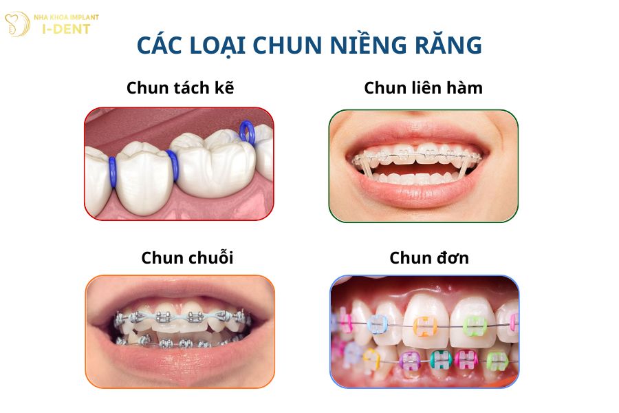 các loại chun niềng răng