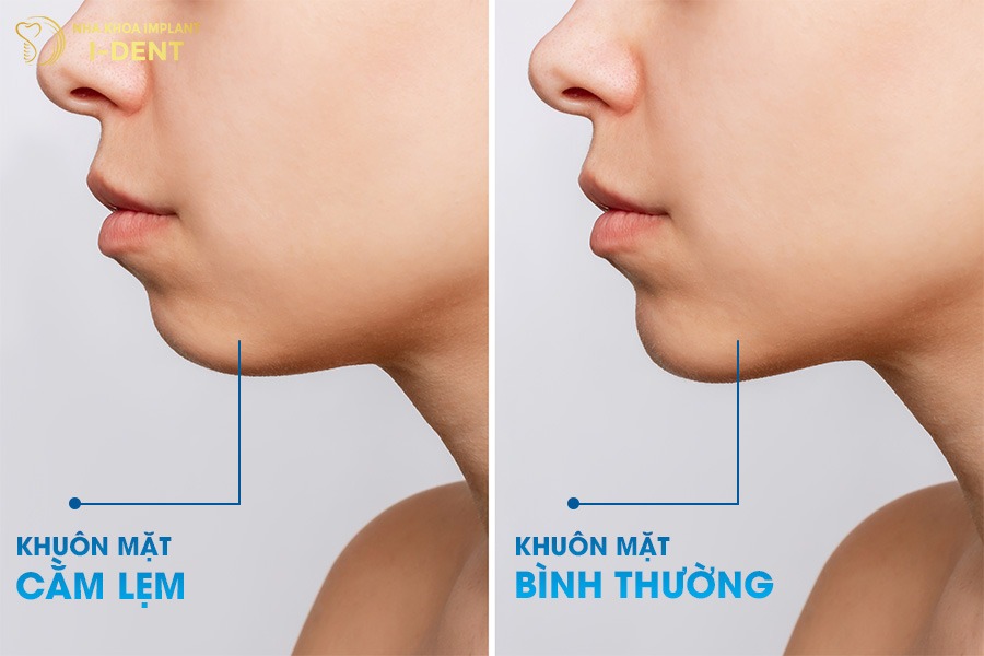 Cằm lẹm khiến đường thẳng nối mũi, môi và cằm không thẳng hàng.