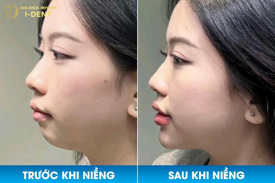 Khách hàng niềng răng tại Nha khoa I-Dent khắc phục tình trạng khuôn mặt kém cân đối do lẹm cằm.