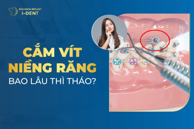 Cắm Vít Niềng Răng Bao Lâu Thì Tháo? Cần Lưu Ý Gì?