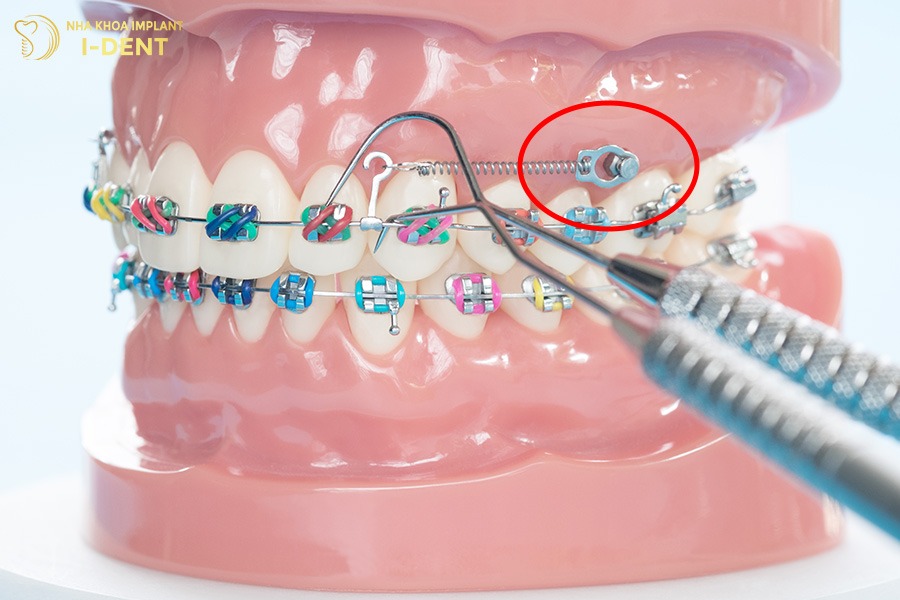 cắm vít niềng răng bao lâu thì tháo