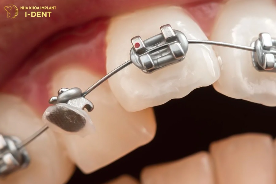 Bạn nên liên hệ bác sĩ ngay nếu gặp tình trạng bung mắc cài.