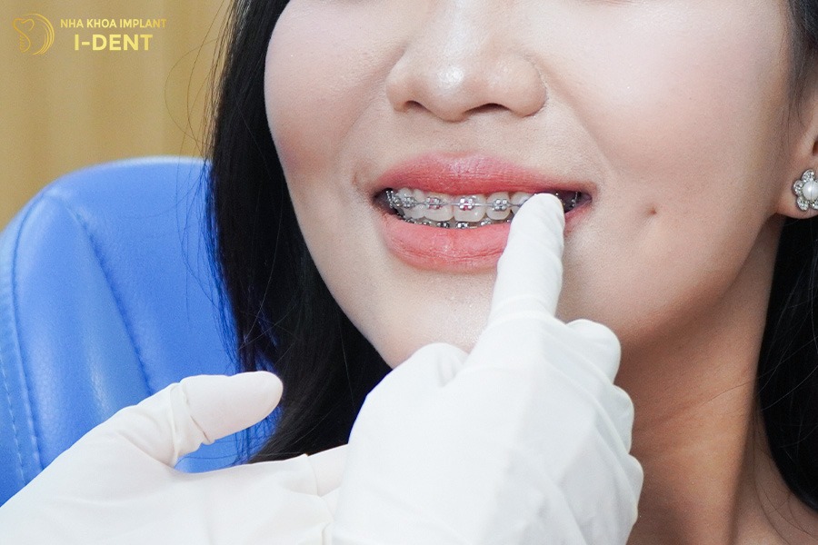 cắm vít niềng răng bao lâu thì tháo