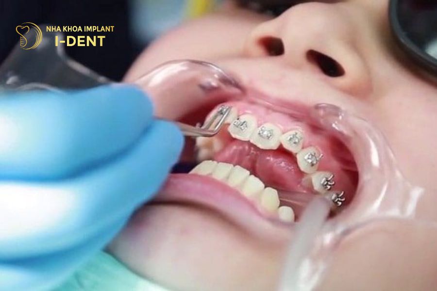 nên niềng răng cho trẻ 11 tuổi 