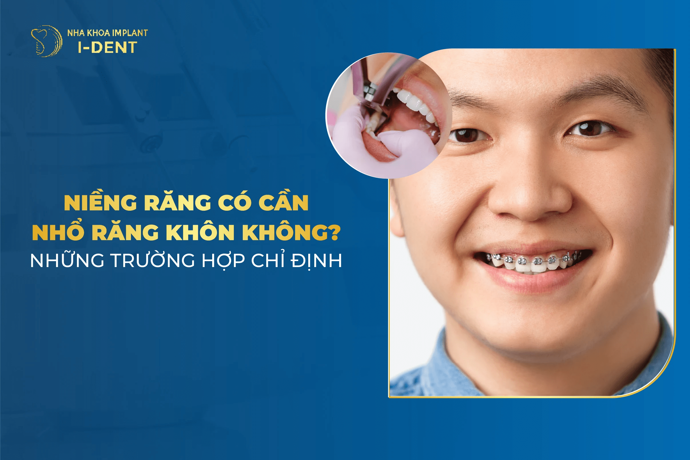 Niềng Răng Có Cần Phải Nhổ Răng Khôn?