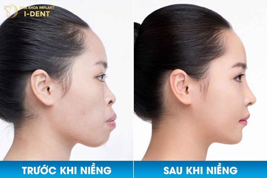 Niềng răng giúp sắp xếp răng thẳng hàng và cải thiện cằm lẹm nhẹ.