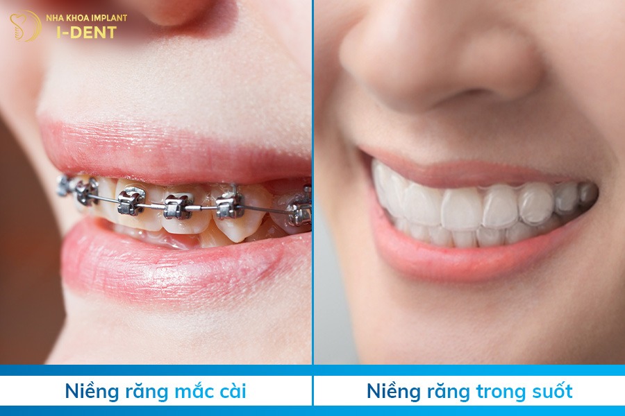 thời gian niềng răng hô