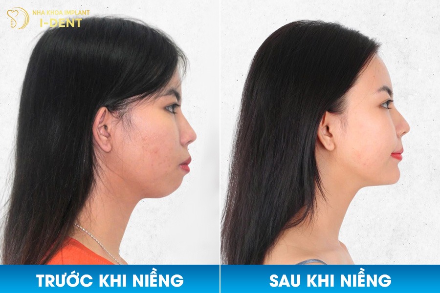 Từ cằm lẹm, khớp cắn sâu, sau khi niềng răng gương mặt đã trở nên hài hòa và thanh thoát hơn.