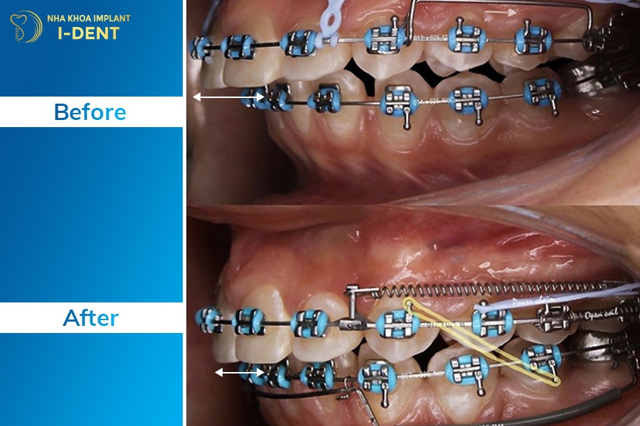niềng răng hô hàm trên bao lâu
