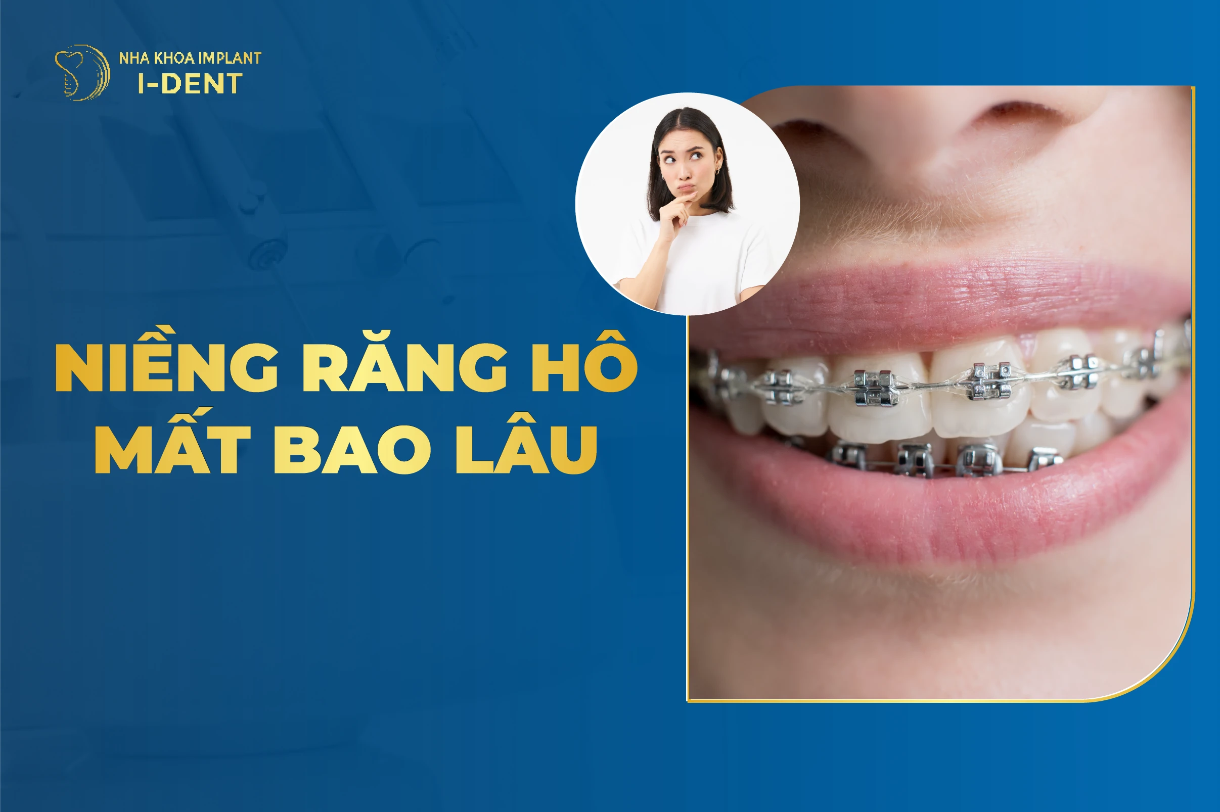 Niềng Răng Hô Nhẹ Mất Bao Lâu Có Hiệu Quả?