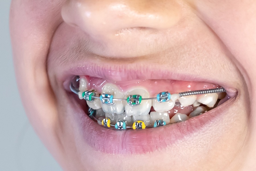 Niềng răng sớm giúp trẻ cải thiện thẩm mỹ nụ cười.