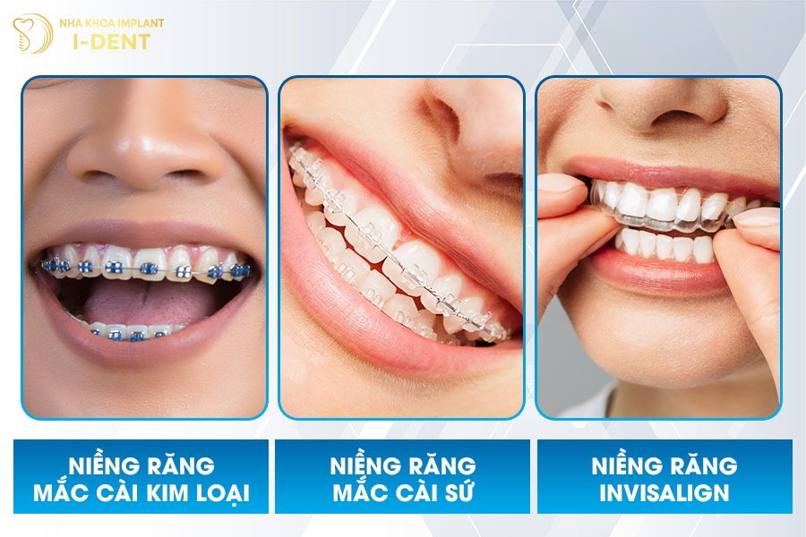 Phương pháp niềng răng điều chỉnh cằm lẹm hiệu quả.