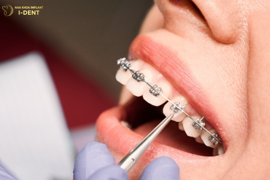 thay dây cung niềng răng