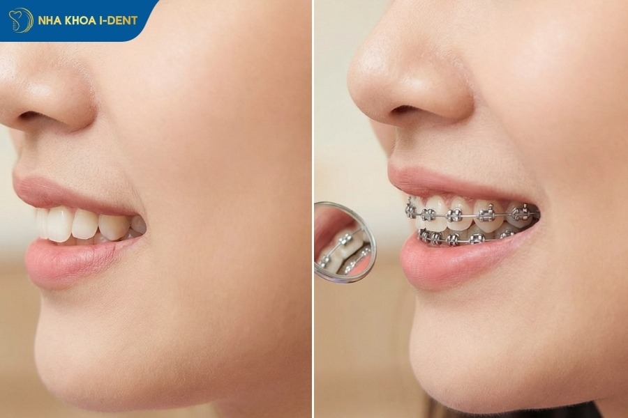 thời gian niềng răng hô