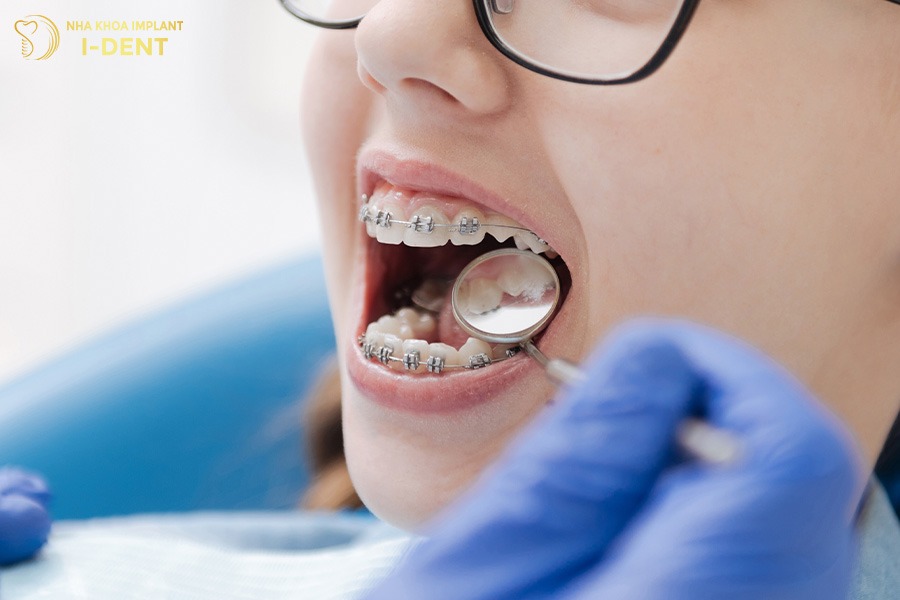 răng hô niềng mất bao lâu