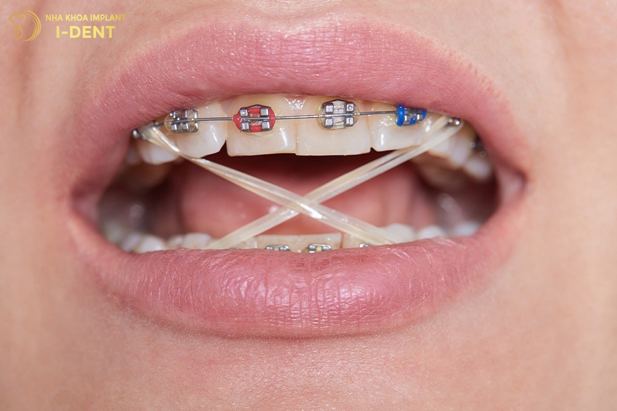 Tránh những thói quen sai khi đeo chun niềng răng để không làm giảm hiệu quả chỉnh nha.