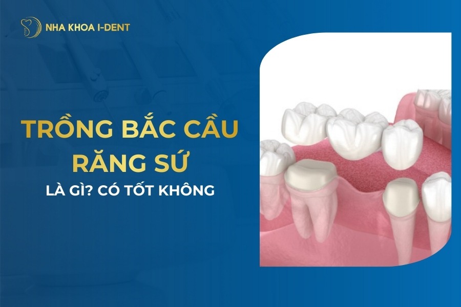 Trồng Răng Bắc Cầu Là Gì? Có Nên Làm Răng Bắc Cầu?